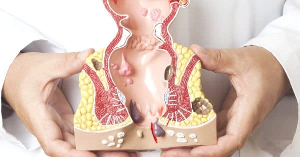 Khi nào cần mổ trĩ nội