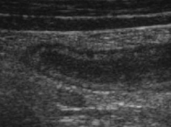 Hình ảnh siêu âm ruột thừa