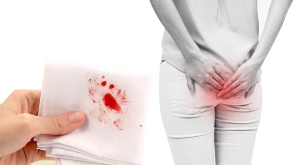 Dấu hiệu nhận biết bệnh trĩ độ 1