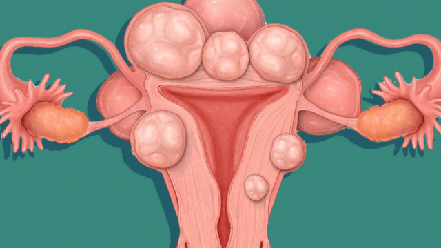 Tổng hợp các phương pháp điều trị u xơ tử cung