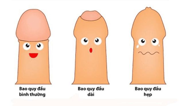 Cách trị hẹp bao quy đầu ở nam giới