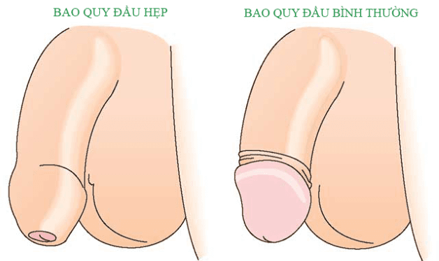 Hẹp bao quy đầu ở nam giới