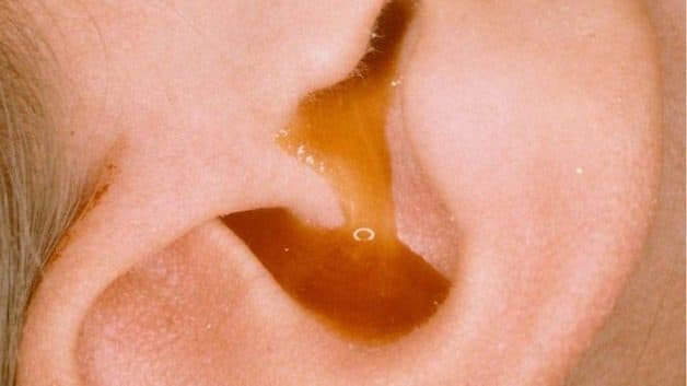 Tai có dịch hoặc mủ là một trong những dấu hiệu phổ biến thường xuất hiện cùng bệnh tai đau.