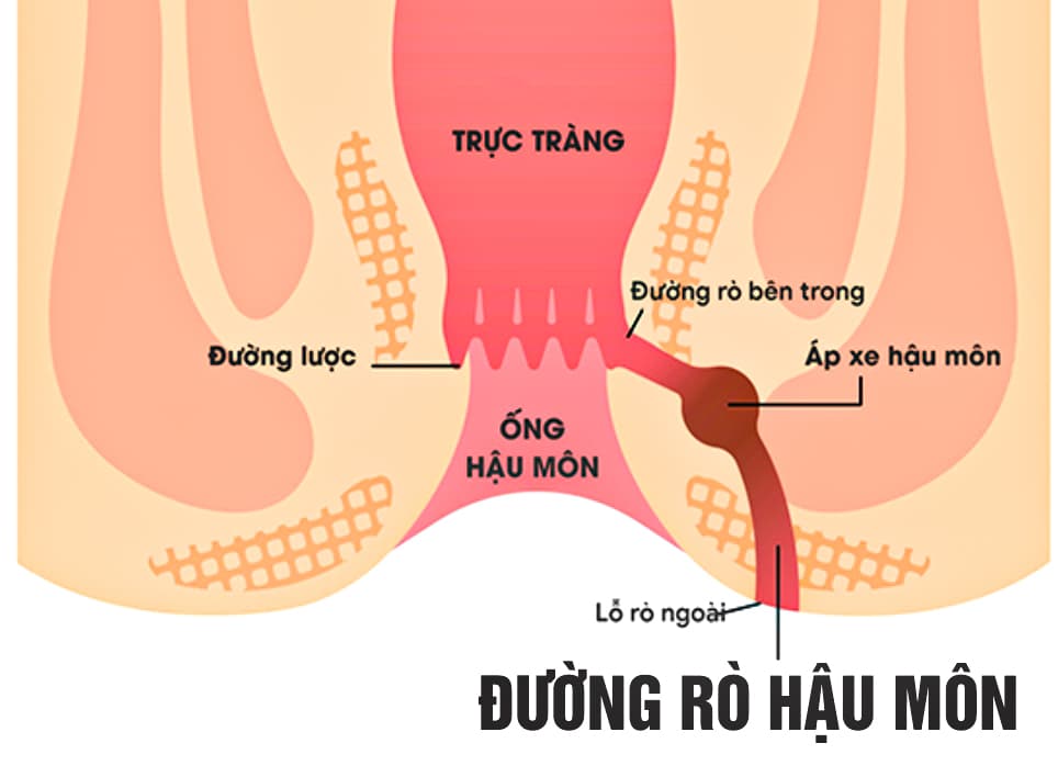 Bệnh rò ở hậu môn thường có triệu chứng