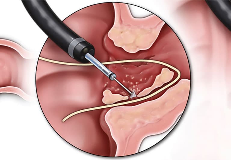 Bệnh rò ở hậu môn thường được điều trị bằng phẫu thuật ít xâm lấn