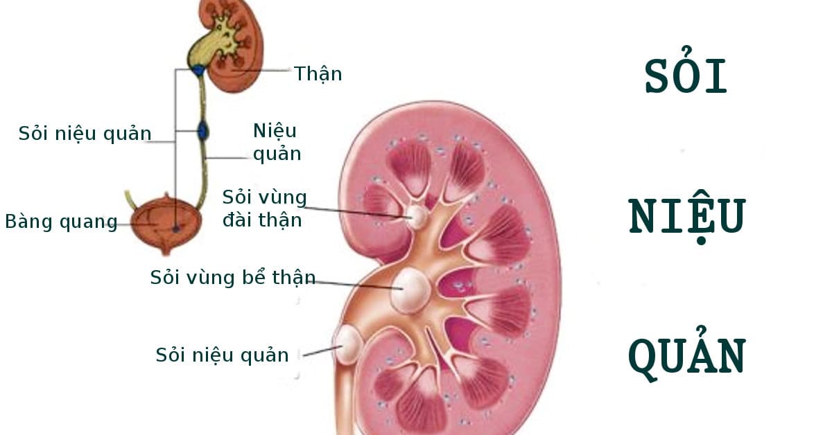 Bệnh sỏi tiết niệu có thể được phân loại theo vị trí và tính chất sỏi