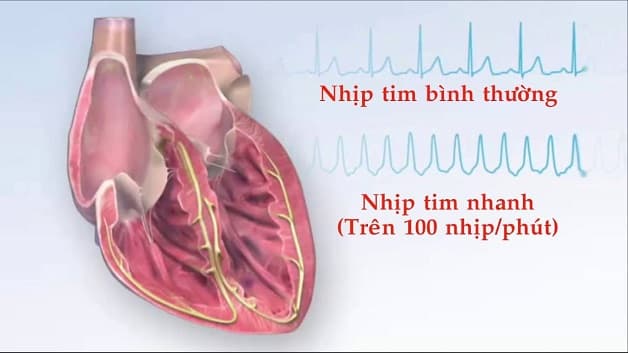 Thông thường, tim đập nhanh là hiện tượng tim đập trên 100 nhịp/phút.