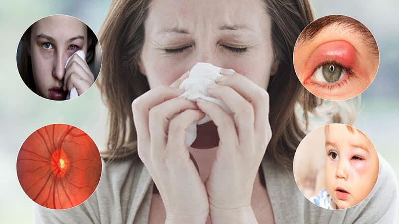 Bị viêm xoang nặng có thể dẫn đến biến chứng về mắt