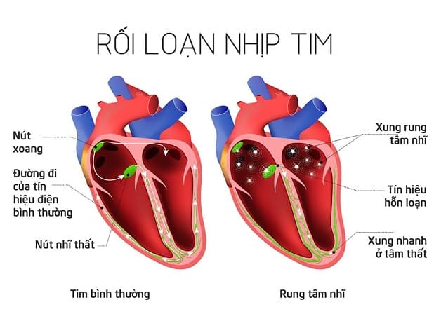 Rung nhĩ là một trong những biến chứng của bệnh tim hở van 2 lá.