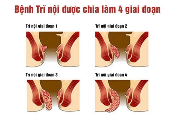 Các cấp độ của trĩ nội