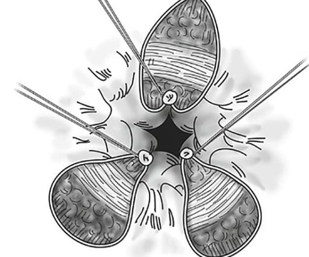 Các phương pháp mổ trĩ hiệu quả