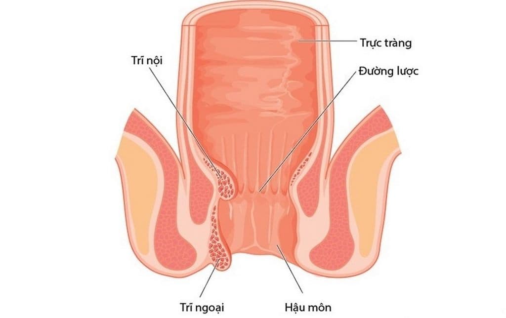 Cách điều trị trĩ ngoại như thế nào