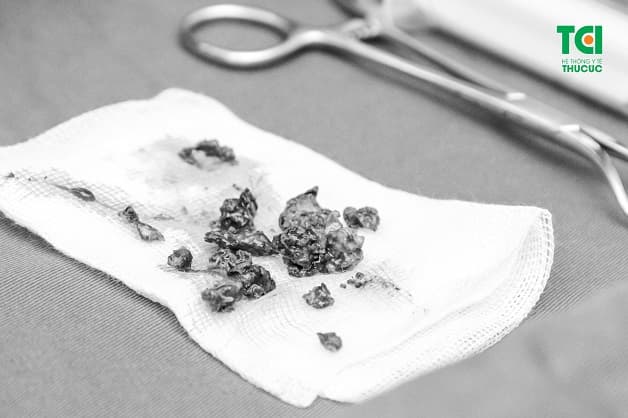 Mẫu bệnh tích viêm xoang do nấm được lấy ra sau phẫu thuật nội soi mũi xoang của một bệnh nhân tại BV ĐKQT Thu Cúc