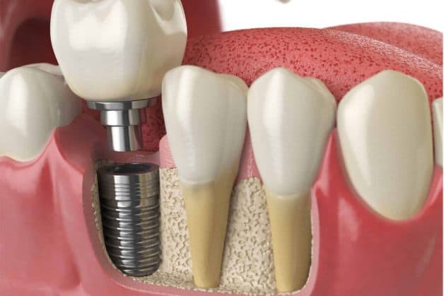 Cấy ghép implant