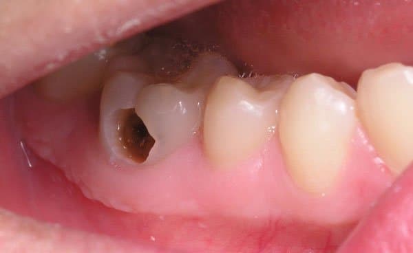 Chụp sứ răng hàm là phương pháp thẩm mỹ áp dụng được cho nhiều khuyết điểm của răng