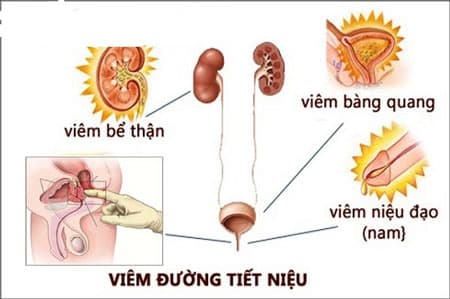 Điều trị viêm tiết niệu nam giới tốt nhất