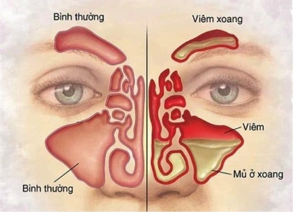 Viêm xoang có thể nói là một trong những bệnh lý đường hô hấp phổ biến nhất