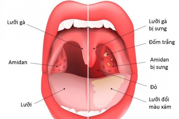 Viêm amidan là một trong số các nguyên nhân phổ biến gây ra hiện tượng nổi hạch phía sau tai.