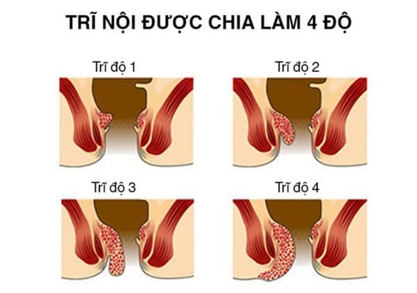 4 cấp độ bệnh trĩ nội