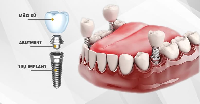 Cấy ghép implant là phương pháp thay thế răng đã mất hiệu quả