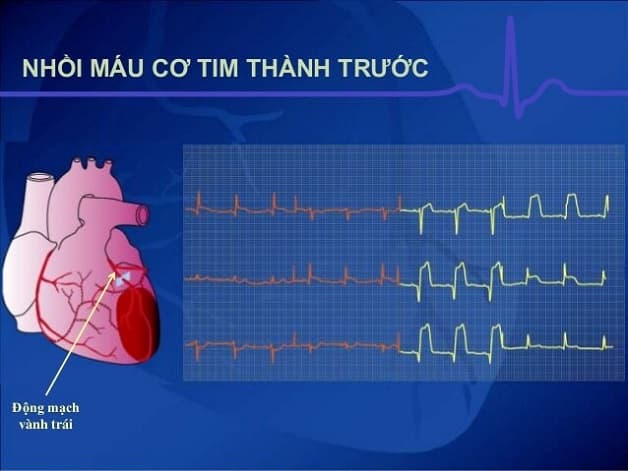 Hình ảnh nhồi máu cơ tim trên ECG thành trước .