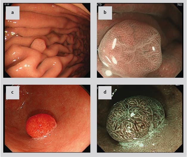Nội soi bao tử phát hiện polyp dạ dày