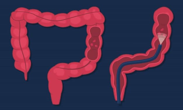 Nội soi đại tràng có đau không?