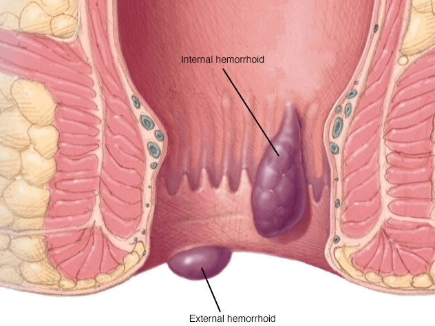Phẫu thuật cắt búi trĩ như thế nào