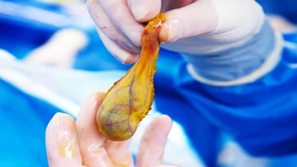 Điều trị trường hợp có polyp ở túi mật