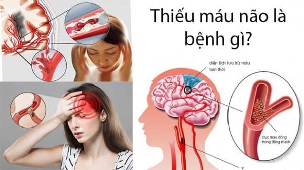 thiếu máu não mất ngủ do nguyên nhân gì