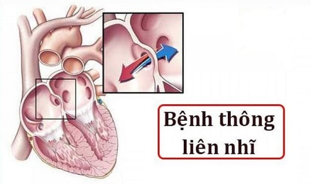 Thông liên nhĩ bệnh tim la gì?