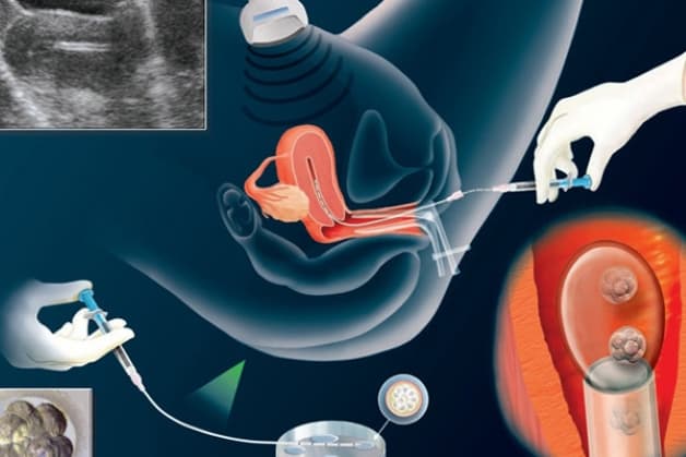 Thụ tinh nhân tạo IUI