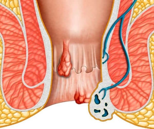 Tắc mạch trĩ ngoại là gì?