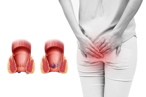 Trĩ nội cấp độ 1 có những triệu chứng nhẹ như ngứa hậu môn, táo bón không thường xuyên...