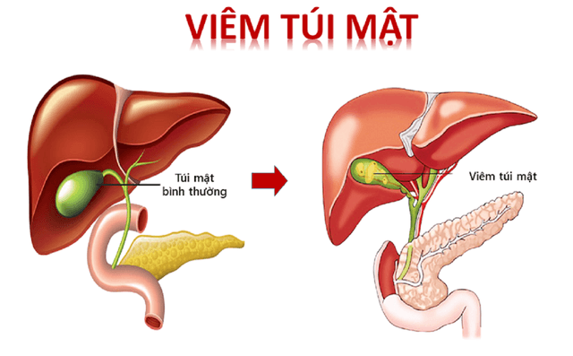 Viêm túi mật cấp điều trị hiệu quả bằng phương pháp nào?
