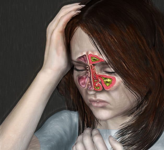 Viêm xoang mũi là tình trạng niêm mạc lót xoang mũi bị tấn công và khiến cho vùng xoang mũi bị viêm nhiễm