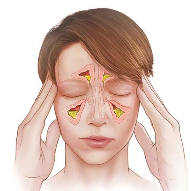 Viêm xoang cấp tính kéo dài khoảng 4 tuần còn viêm xoang mạn tính kéo dài hơn 3 tháng