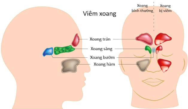 Viêm xoang sàng là tình trạng một hoặc các hốc xoang sàng bị nhiễm trùng, khiến lớp niêm mạc tại các hốc xoang bị tổn thương.