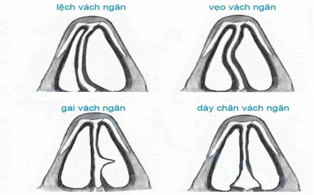 Những người có cấu trúc vách ngăn mũi bất thường (lệch, vẹo, có gờ...) hoặc hốc xoang nhỏ, hẹp, có polyp... thường có nguy cơ mắc bệnh cao hơn.