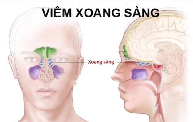 Viêm xoang sàng sau là gì? Là hiện tượng lớp niêm mạc bao phủ bề mặt hốc xoang sàng sau bị nhiễm trùng, gây ứ dịch.