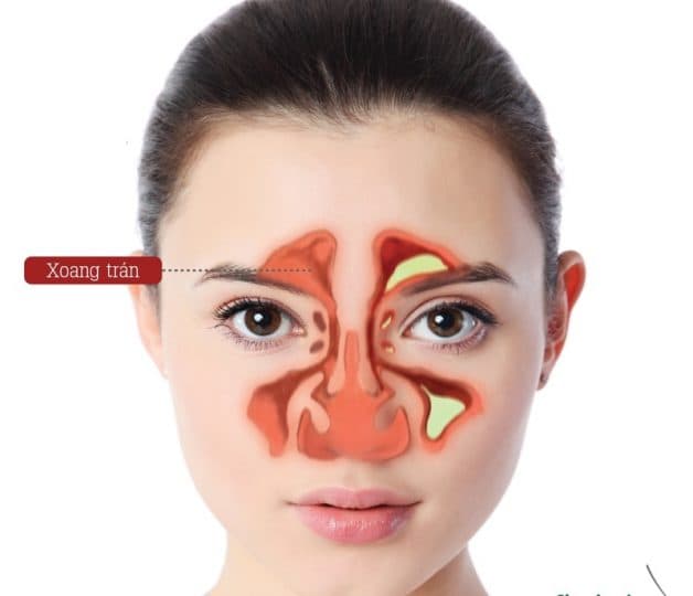 viêm xoang trán xảy ra khi chất nhầy không thoát ra được và bị giữ lại trong xoang, khiến cho khu vực mắt và trán bị tăng áp lực.