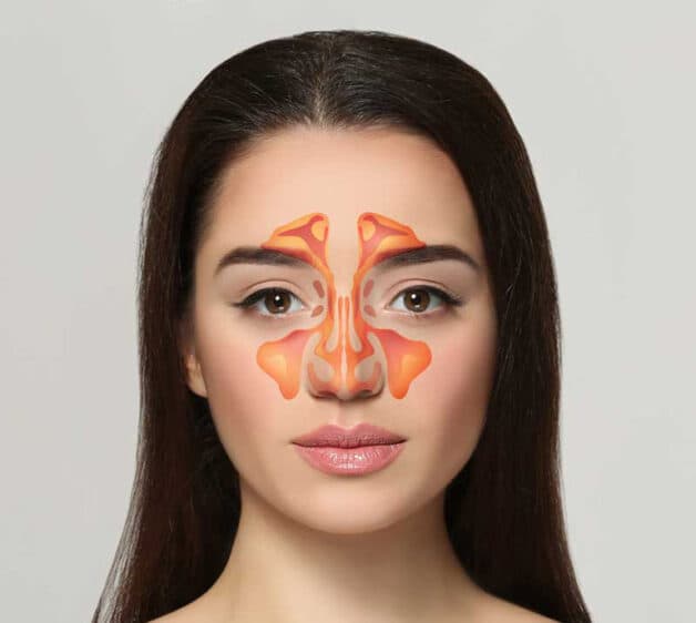 Viêm xoang mũi được chia làm 4 loại tùy vào thời gian mắc bệnh