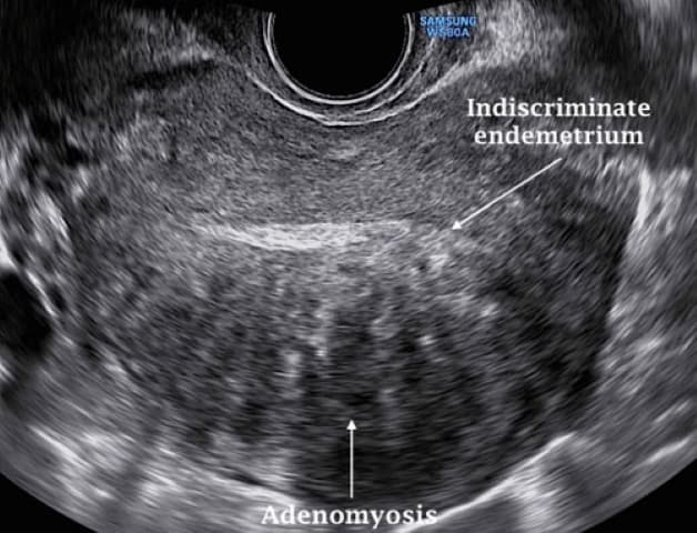 Hình ảnh siêu âm lạc nội mạc tử cung