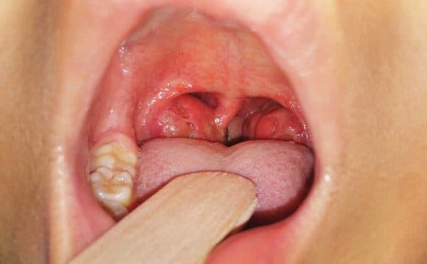 Viêm amidan xảy ra khi amidan bị nhiễm trùng do virus hoặc vi khuẩn xâm nhập