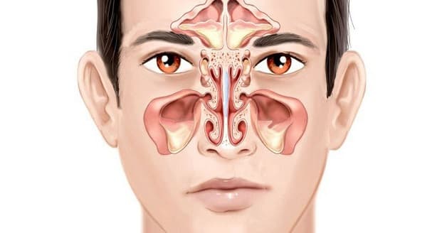 Viêm xoang là tình trạng nhiễm trùng ở một hoặc nhiều xoang bởi xoang bị tắc nghẽn