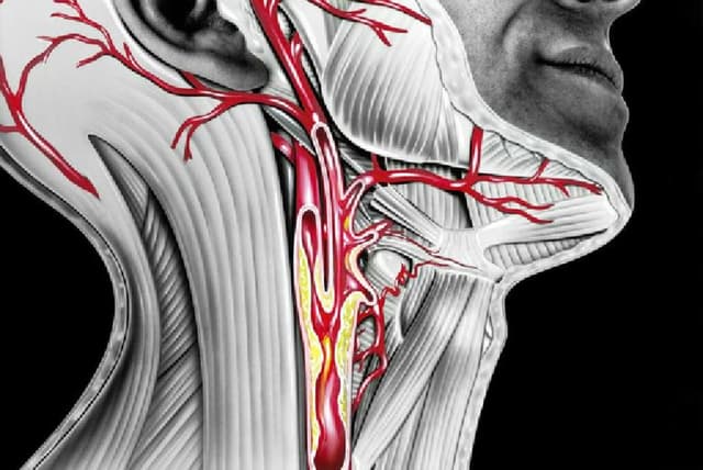 5 loại xơ vữa động mạch phổ biến và triệu chứng nhận biết