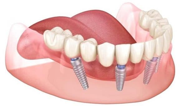 Cấy ghép Implant là giải pháp hoàn hảo cho người mất răng
