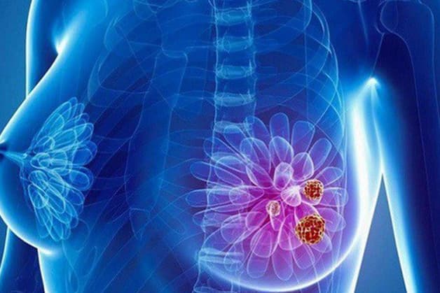 có nên tầm soát ung thư vú