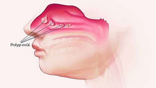 Polyp mũi thực chất là khối u lành tính được hình thành từ lớp niêm mạc của mũi hoặc của các xoang.