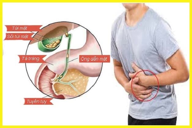 Điều trị sỏi mật cần tuân thủ những gì